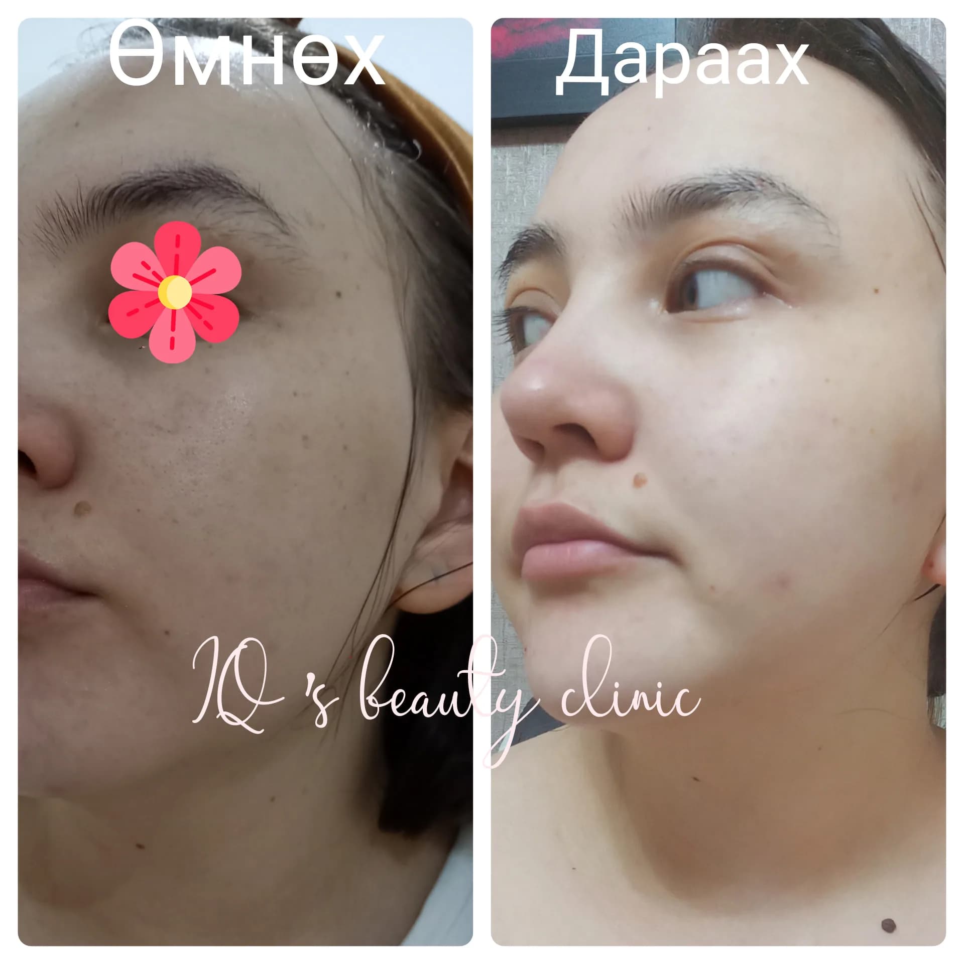 MTS + PRP бичил эд эсийн эмчилгээ